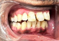 Post Op Image 4-24-25-2