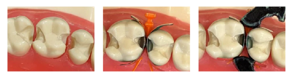 VursaWedge-Quadrant-Dentistry