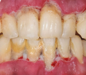 Periodontal Disease-1